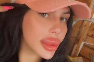 Model who once had UKs 'biggest lips' injects filler at home for 'fake look again'