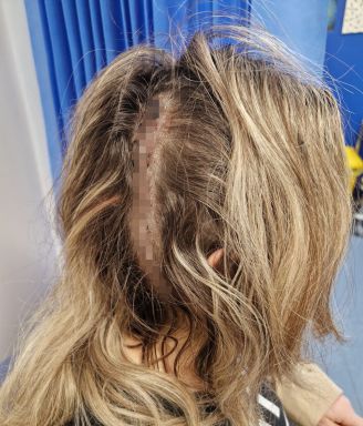 Sarah's brain surgery scar.