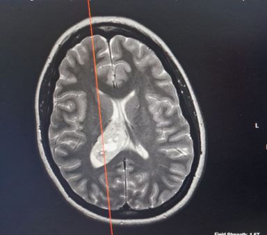 Sarah's brain scan